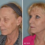 Blepharoplasty Before and After Photos in Miami, FL, Patient 1201