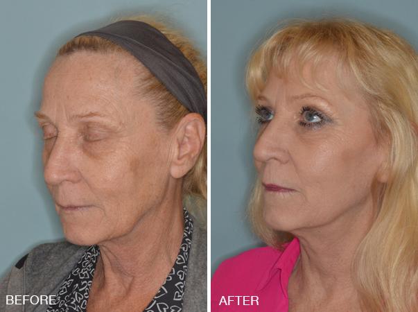 Blepharoplasty Before and After Photos in Miami, FL, Patient 1201