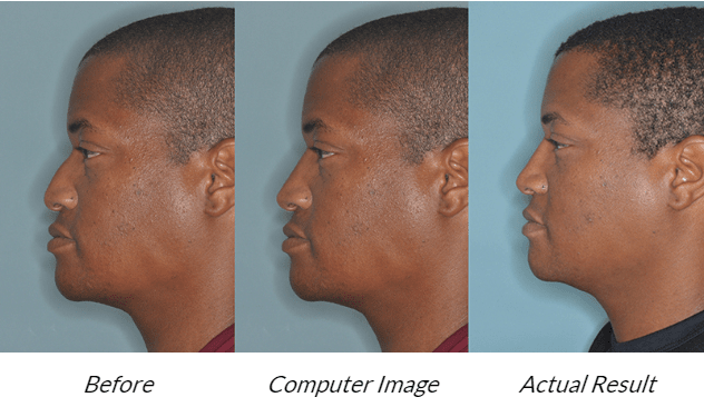 rhinoplasty - Computer Image vs Actual Result Comparison 1