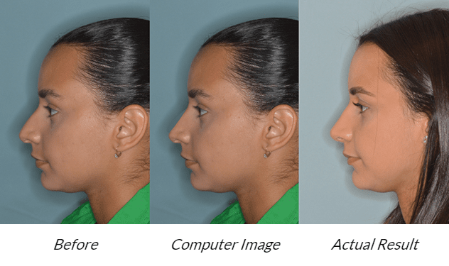 rhinoplasty - Computer Image vs Actual Result Comparison 2