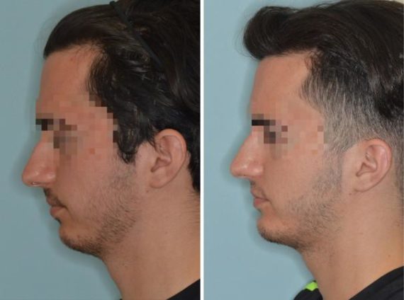 Chin Augmentation Before and After Photos in Miami, FL, Patient 1452