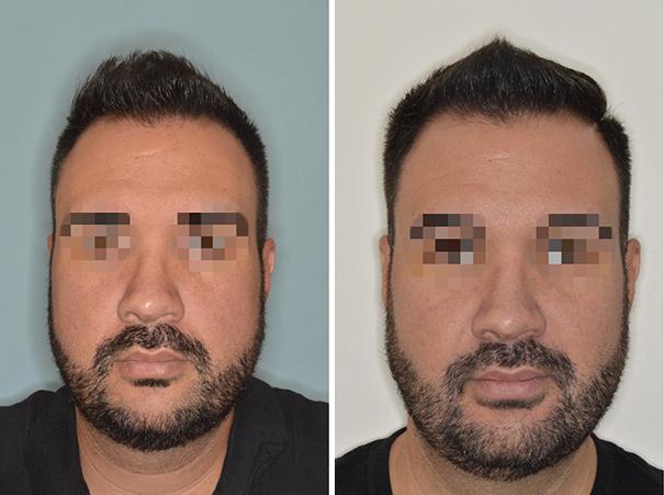 Patient 1445, Cheek Reduction Before and After Photos Cheek Reduction Before and After Photos in Miami, FL, Patient 1445