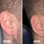 Earlobe Repair Before and After Photos in Miami, FL, Patient 1389