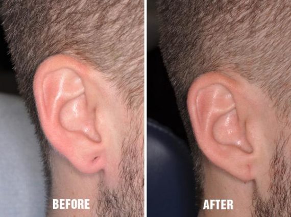 Earlobe Repair Before and After Photos in Miami, FL, Patient 1389