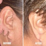 Earlobe Repair Before and After Photos in Miami, FL, Patient 1396