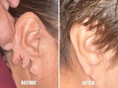 Earlobe Repair Before and After Photos in Miami, FL, Patient 1396