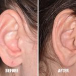 Earlobe Repair Before and After Photos in Miami, FL, Patient 1400