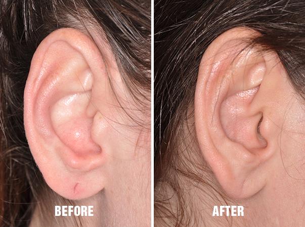 Earlobe Repair Before and After Photos in Miami, FL, Patient 1400