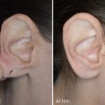 Earlobe Repair Before and After Photos in Miami, FL, Patient 1406