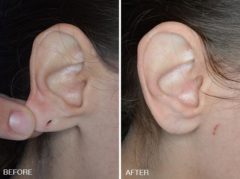 Earlobe Repair Before and After Photos in Miami, FL, Patient 1406