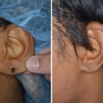 Earlobe Repair Before and After Photos in Miami, FL, Patient 1408