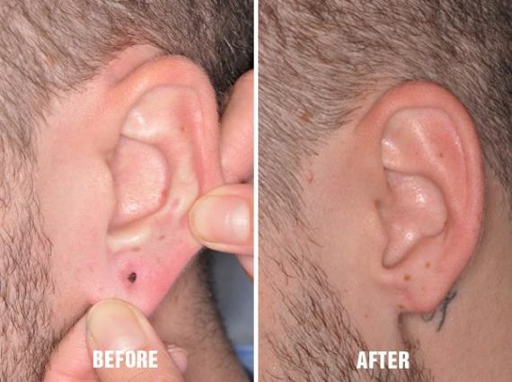 Earlobe Repair Before and After Photos in Miami, FL, Patient 1389