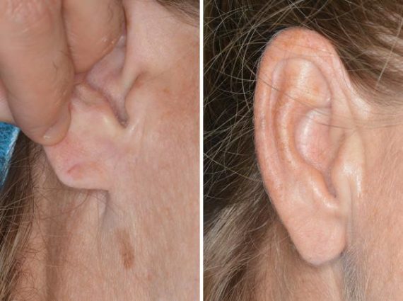 Earlobe Repair Before and After Photos in Miami, FL, Patient 1412