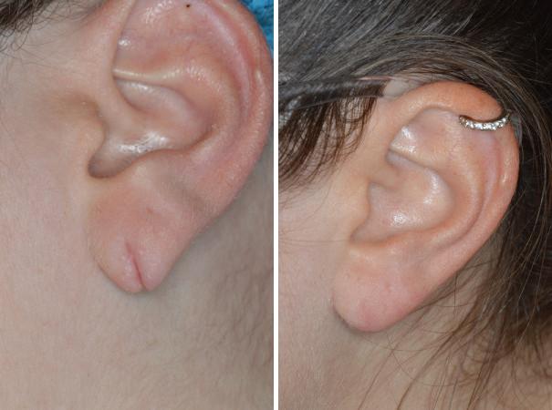 Earlobe Repair Before and After Photos in Miami, FL, Patient 1416