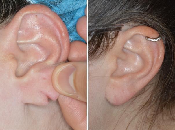 Earlobe Repair Before and After Photos in Miami, FL, Patient 1416