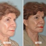 Facelift Before and After Photos in Miami, FL, Patient 1093