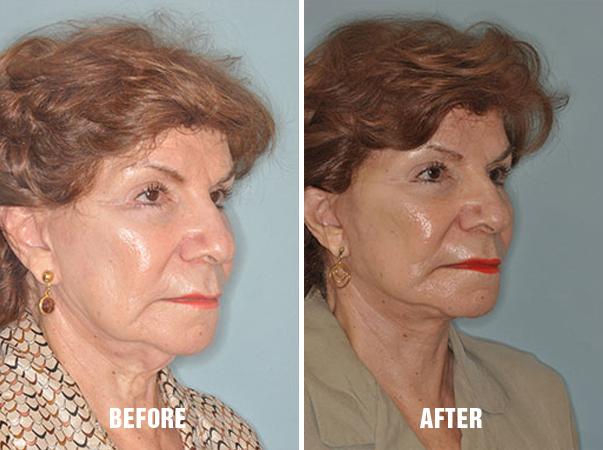 Facelift Before and After Photos in Miami, FL, Patient 1093
