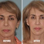 Facelift Before and After Photos in Miami, FL, Patient 1126