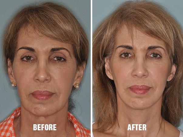 Facelift Before and After Photos in Miami, FL, Patient 1126