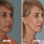 Facelift Before and After Photos in Miami, FL, Patient 1126