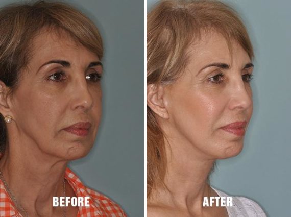 Facelift Before and After Photos in Miami, FL, Patient 1126