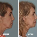 Facelift Before and After Photos in Miami, FL, Patient 1126