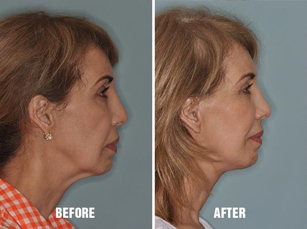 Facelift Before and After Photos in Miami, FL, Patient 1126