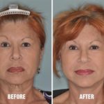 Blepharoplasty Before and After Photos in Miami, FL, Patient 1142