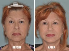 Blepharoplasty Before and After Photos in Miami, FL, Patient 1142