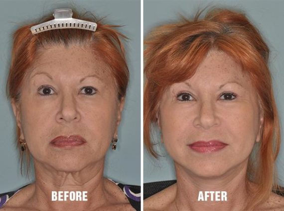 Blepharoplasty Before and After Photos in Miami, FL, Patient 1142