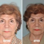 Facelift Before and After Photos in Miami, FL, Patient 1093