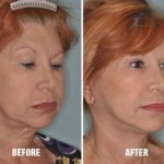 Blepharoplasty Before and After Photos in Miami, FL, Patient 1142