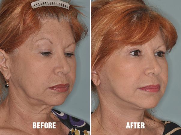 Blepharoplasty Before and After Photos in Miami, FL, Patient 1142