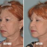 Blepharoplasty Before and After Photos in Miami, FL, Patient 1142