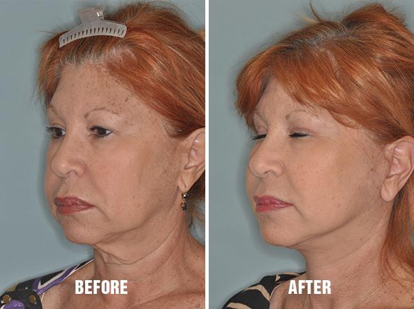 Blepharoplasty Before and After Photos in Miami, FL, Patient 1142