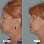 Blepharoplasty Before and After Photos in Miami, FL, Patient 1142