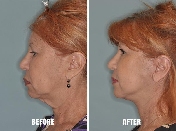 Blepharoplasty Before and After Photos in Miami, FL, Patient 1142