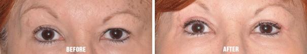 Blepharoplasty Before and After Photos in Miami, FL, Patient 1142