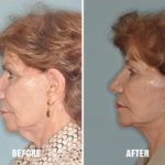 Facelift Before and After Photos in Miami, FL, Patient 1093