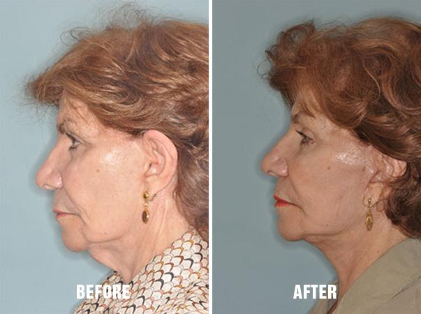 Facelift Before and After Photos in Miami, FL, Patient 1093