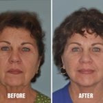 Facelift Before and After Photos in Miami, FL, Patient 1158
