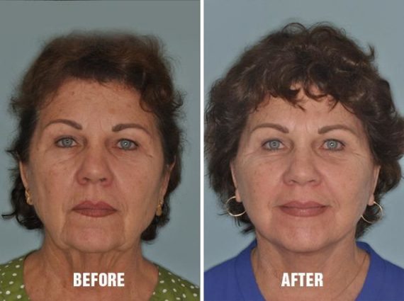 Facelift Before and After Photos in Miami, FL, Patient 1158