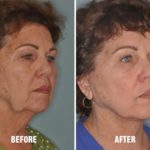 Facelift Before and After Photos in Miami, FL, Patient 1158