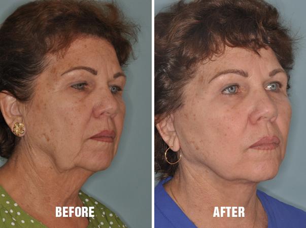 Facelift Before and After Photos in Miami, FL, Patient 1158
