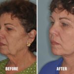 Facelift Before and After Photos in Miami, FL, Patient 1158