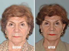 Facelift Before and After Photos in Miami, FL, Patient 1093