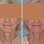 Facelift Before and After Photos in Miami, FL, Patient 1233