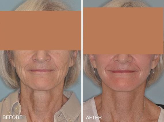 Facelift Before and After Photos in Miami, FL, Patient 1233