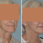 Facelift Before and After Photos in Miami, FL, Patient 1233
