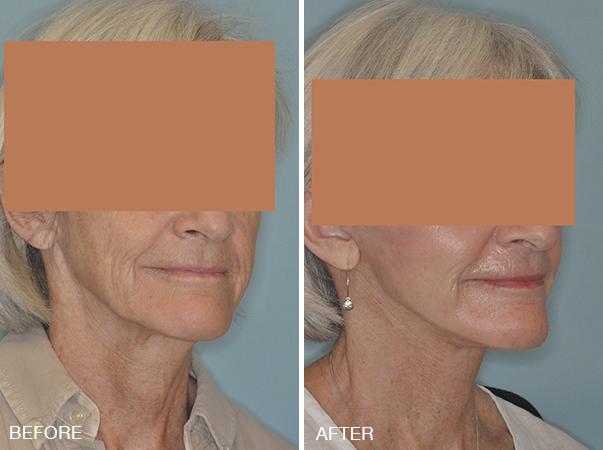 Facelift Before and After Photos in Miami, FL, Patient 1233
